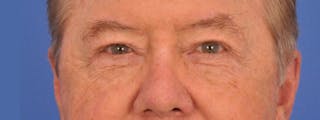 Blepharoplasty Before & After Gallery - Patient 192201 - Image 2