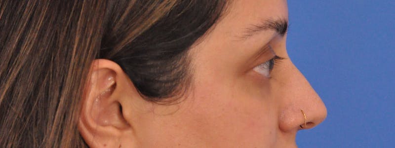 Blepharoplasty Before & After Gallery - Patient 111599 - Image 9