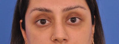 Blepharoplasty Before & After Gallery - Patient 111599 - Image 1