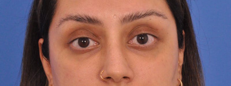 Blepharoplasty Before & After Gallery - Patient 111599 - Image 1