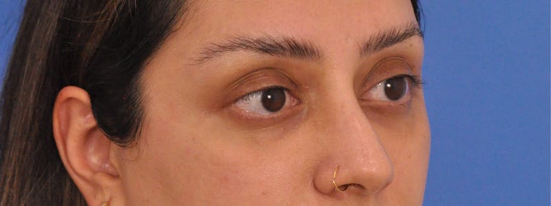 Blepharoplasty Before & After Gallery - Patient 111599 - Image 3