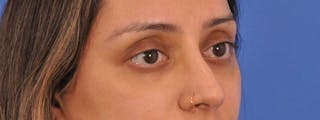 Blepharoplasty Before & After Gallery - Patient 111599 - Image 4