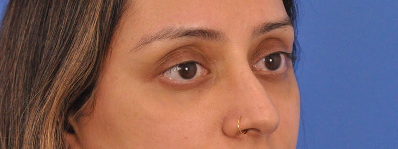 Blepharoplasty Before & After Gallery - Patient 111599 - Image 4