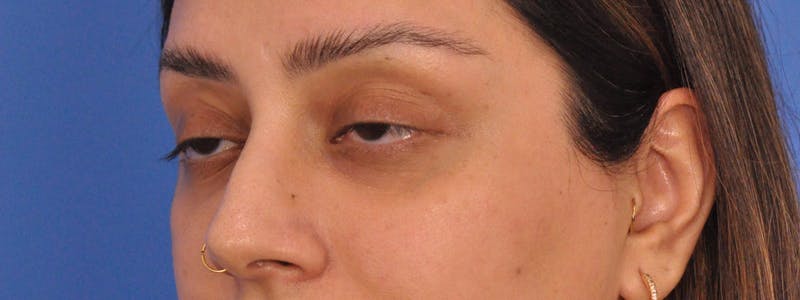 Blepharoplasty Before & After Gallery - Patient 111599 - Image 5