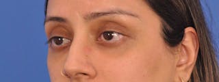 Blepharoplasty Before & After Gallery - Patient 111599 - Image 6