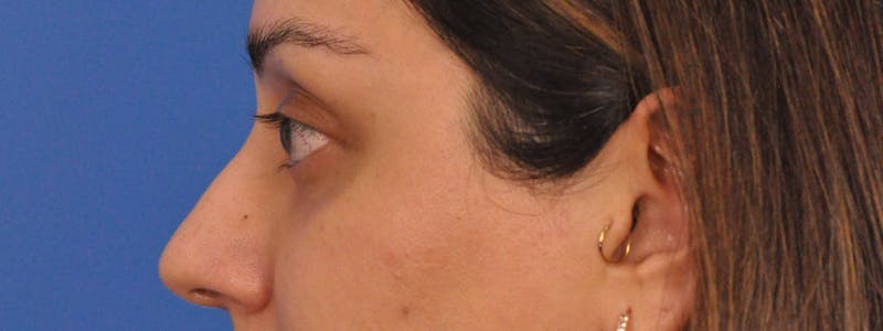 Blepharoplasty Before & After Gallery - Patient 111599 - Image 7