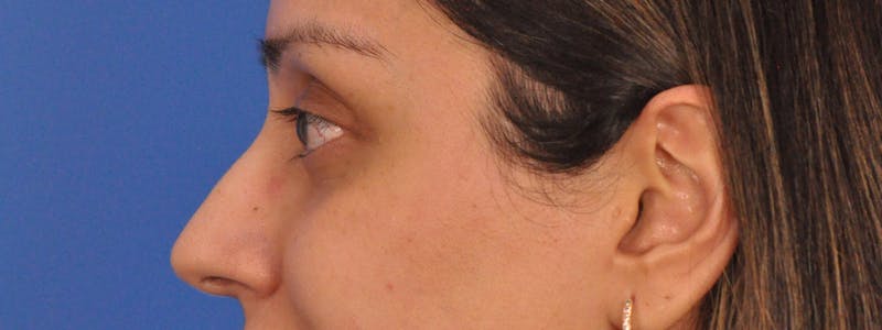 Blepharoplasty Before & After Gallery - Patient 111599 - Image 8