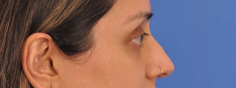 Blepharoplasty Before & After Gallery - Patient 111599 - Image 10