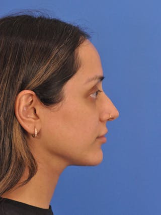 Neck Lift Before & After Gallery - Patient 403717 - Image 2