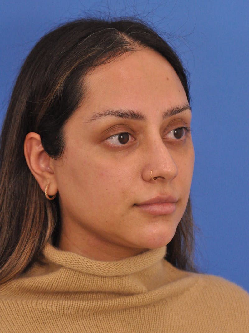 Neck Lift Before & After Gallery - Patient 403717 - Image 5