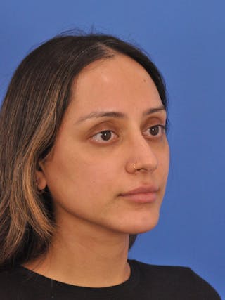 Neck Lift Before & After Gallery - Patient 403717 - Image 6