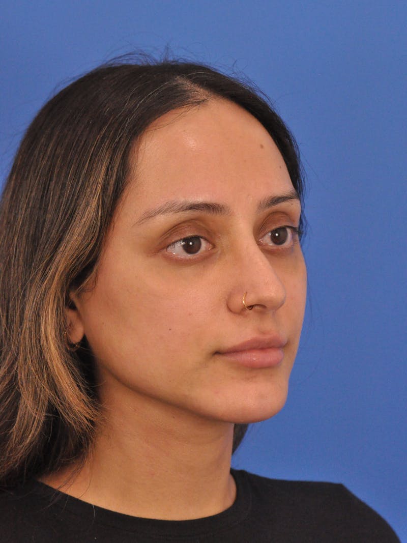 Neck Lift Before & After Gallery - Patient 403717 - Image 6