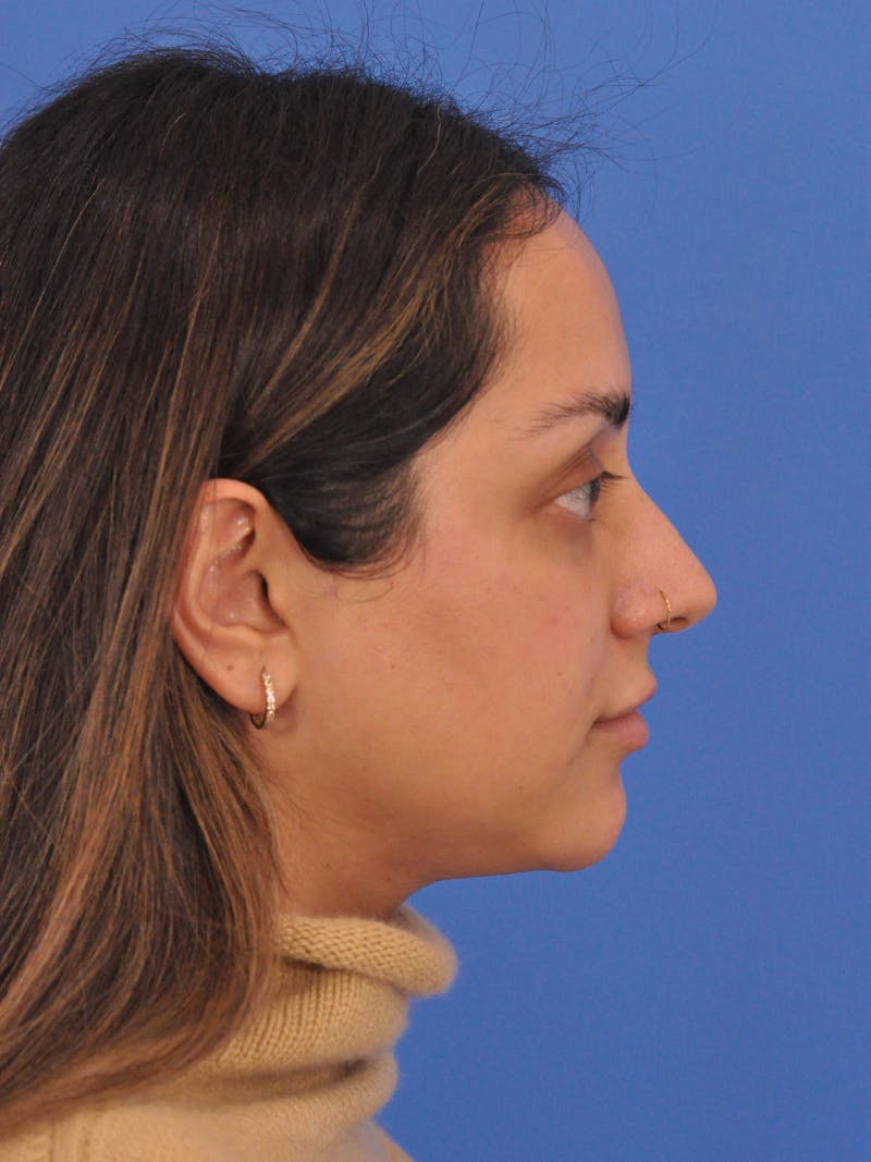 Neck Lift Before & After Gallery - Patient 403717 - Image 1