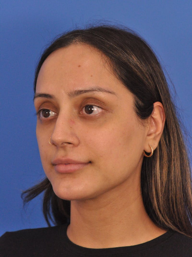 Neck Lift Before & After Gallery - Patient 403717 - Image 8