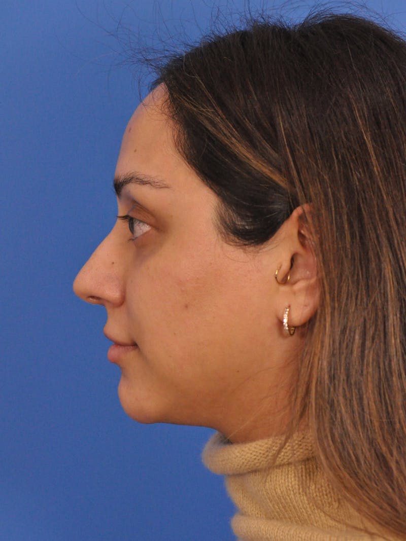 Neck Lift Before & After Gallery - Patient 403717 - Image 3