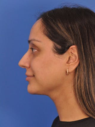 Neck Lift Before & After Gallery - Patient 403717 - Image 4
