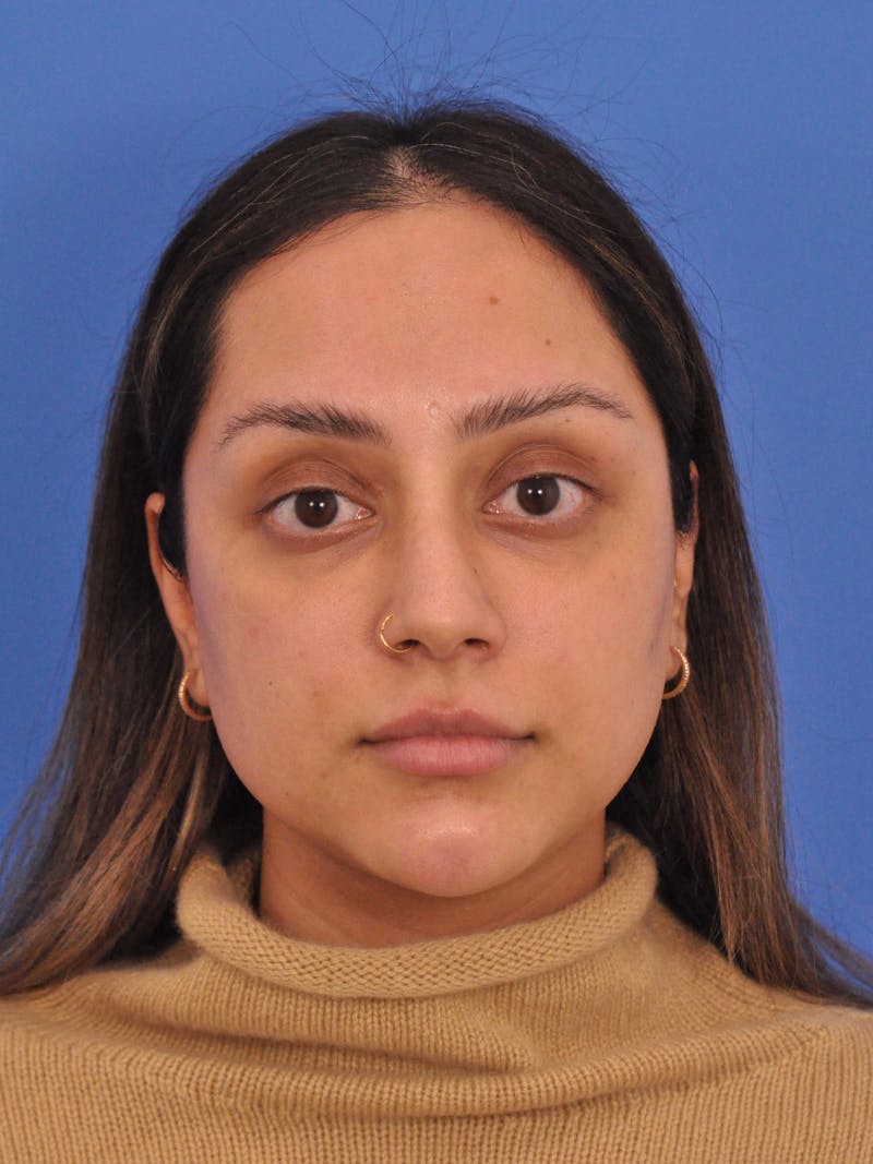 Neck Lift Before & After Gallery - Patient 403717 - Image 9