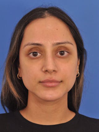 Neck Lift Before & After Gallery - Patient 403717 - Image 10