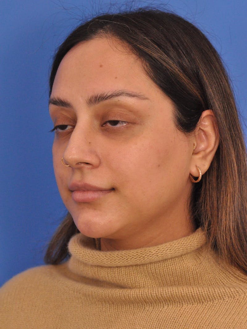 Neck Lift Before & After Gallery - Patient 403717 - Image 7