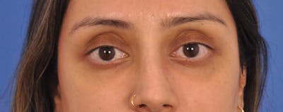 Blepharoplasty Before & After Gallery - Patient 111599 - Image 2