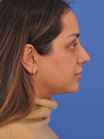 Chin Augmentation Before & After Gallery - Patient 281080 - Image 1