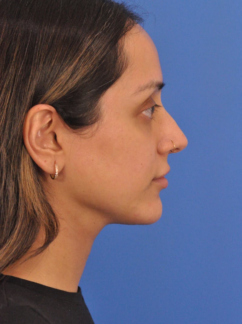 Chin Augmentation Before & After Gallery - Patient 281080 - Image 2