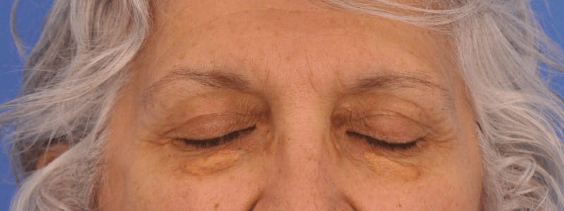Blepharoplasty Before & After Gallery - Patient 246688 - Image 1