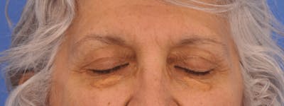 Blepharoplasty Before & After Gallery - Patient 246688 - Image 1