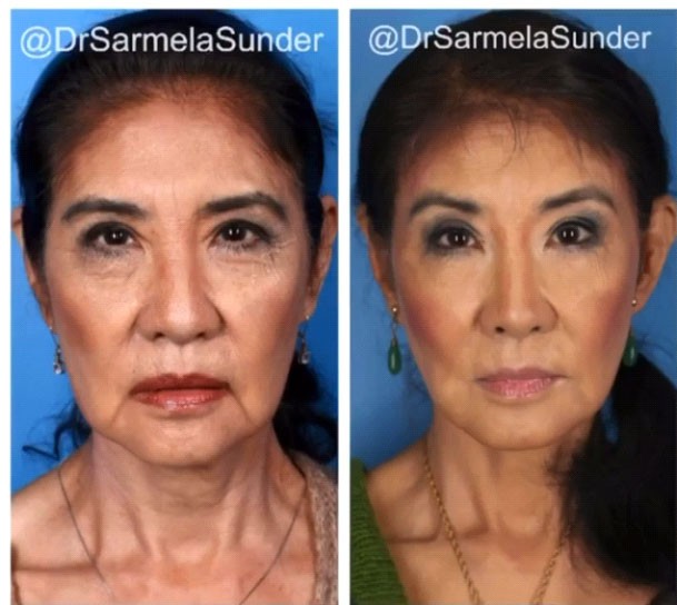 Before & After Facelift images