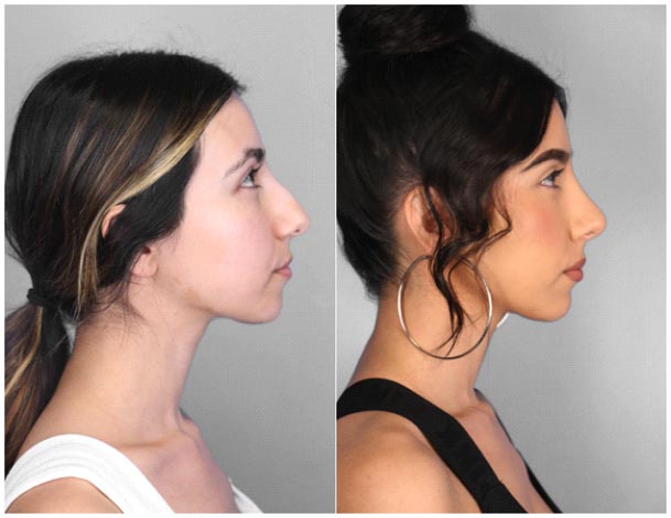 Before & After Rhinoplasty Images