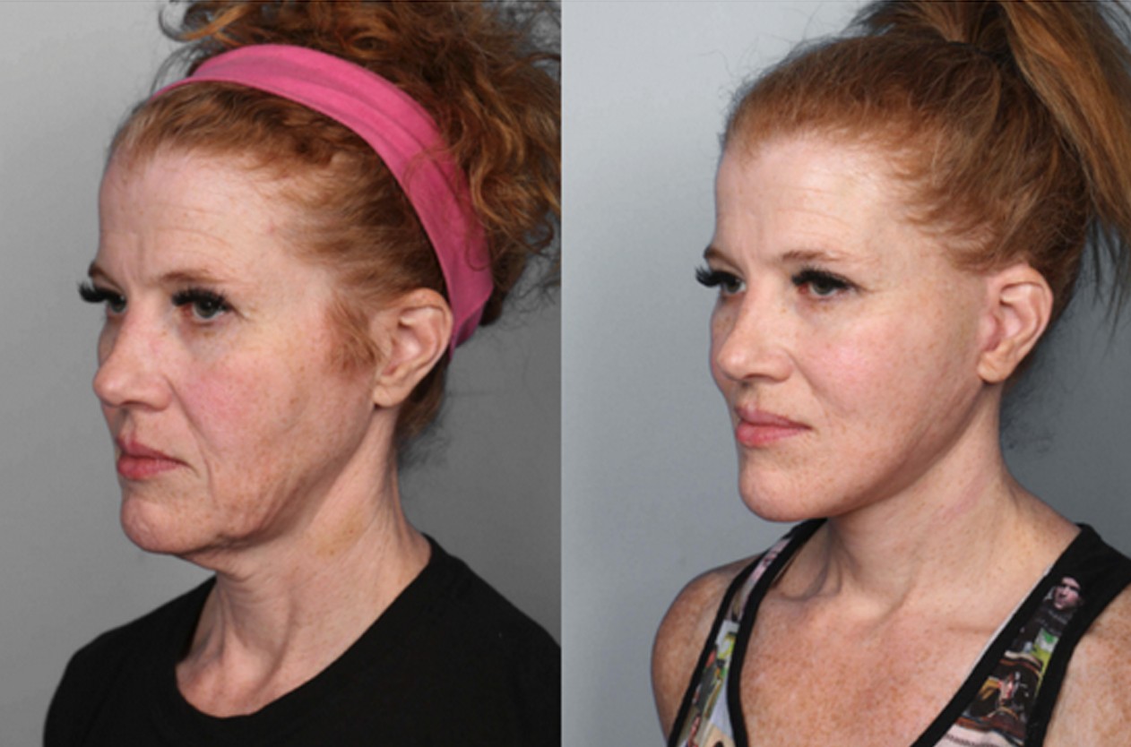 What-are-the-results-of-a-neck-lift