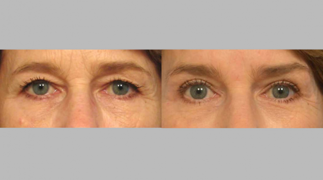 Before & After blepharoplasty images