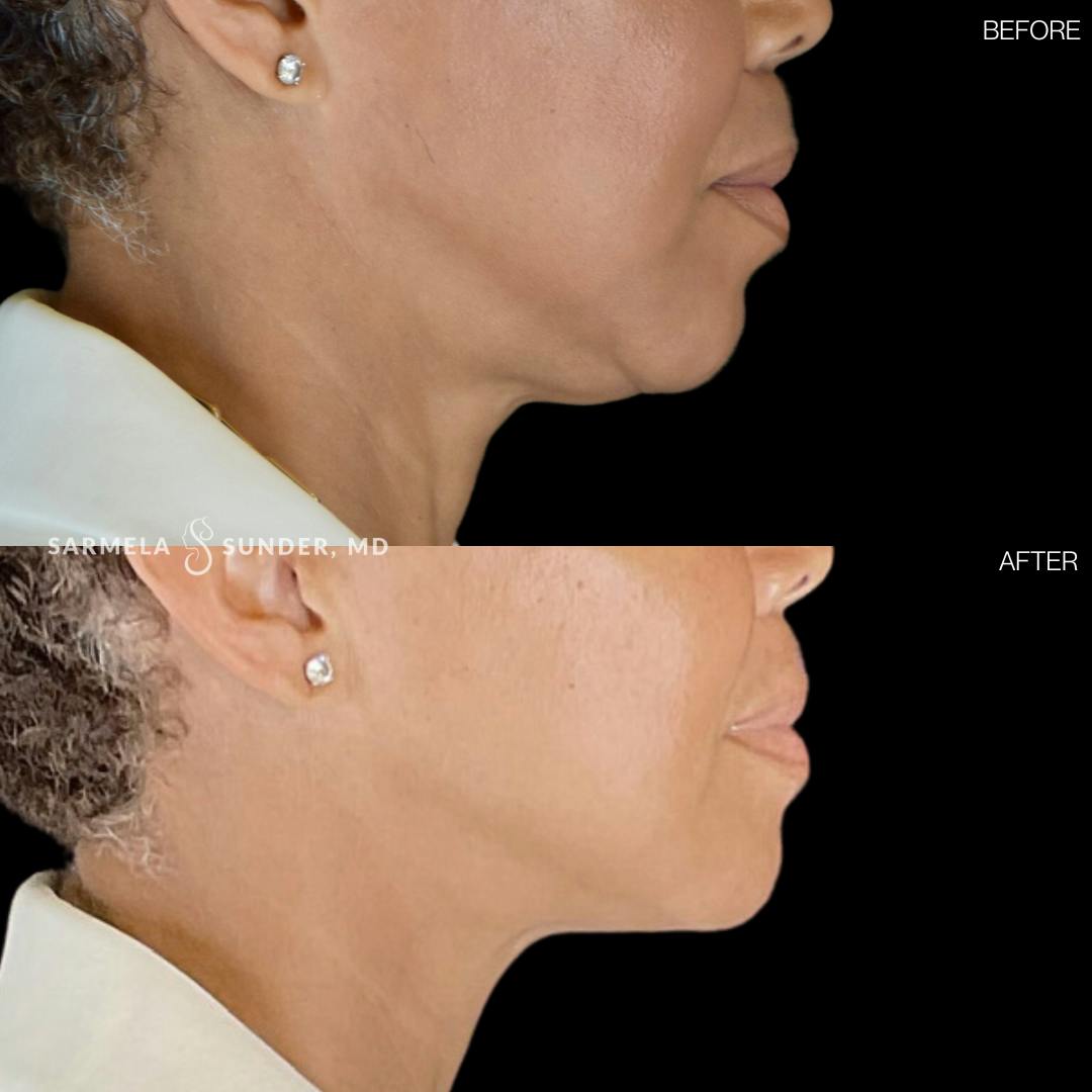 Sofwave Before & After Gallery - Patient 177616153 - Image 1