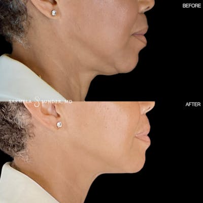 Sofwave Before & After Gallery - Patient 177616153 - Image 1