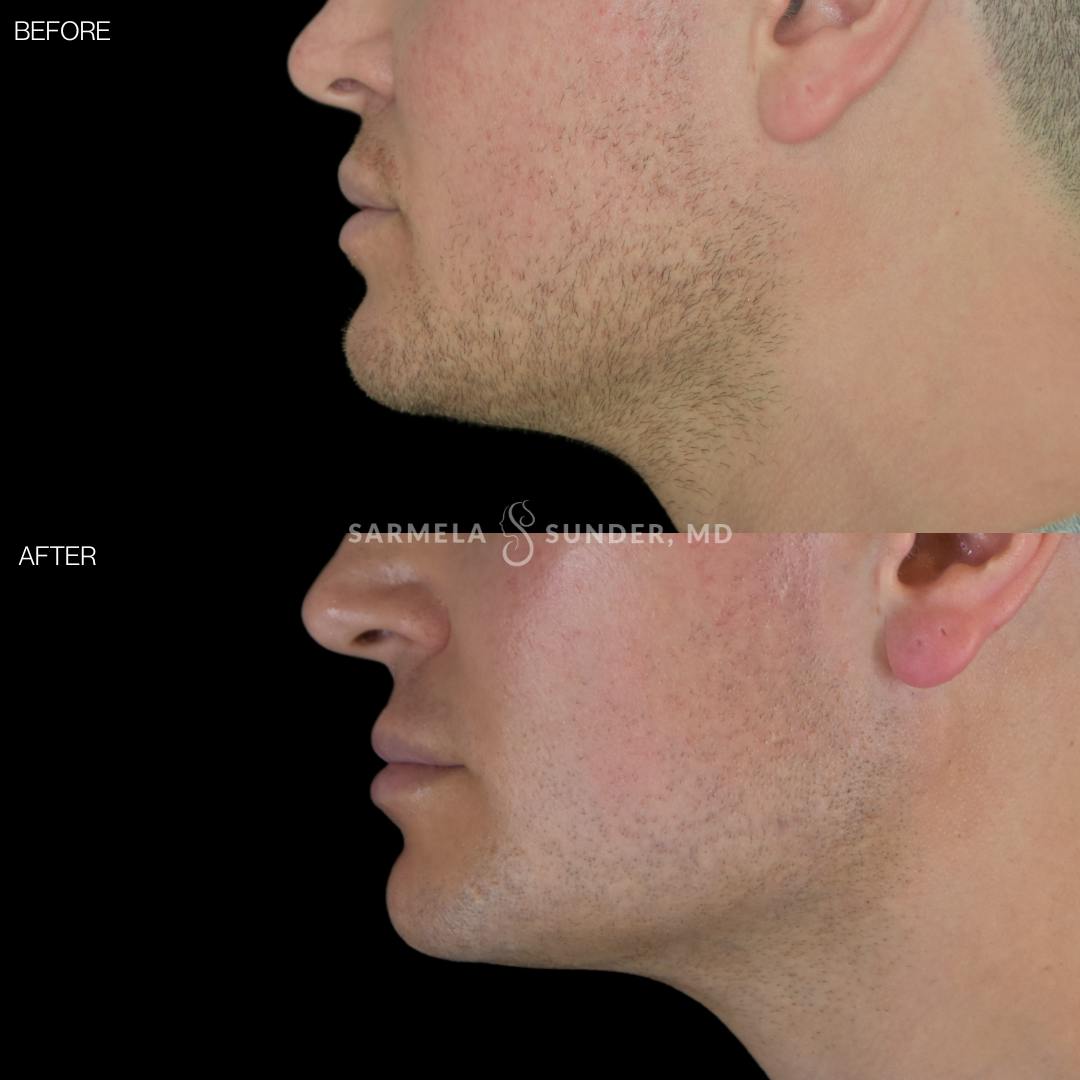 Sofwave Before & After Gallery - Patient 177616063 - Image 1