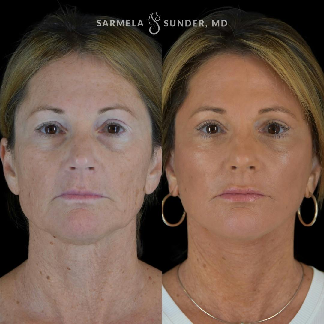 Facelift Before & After Gallery - Patient 230825 - Image 1