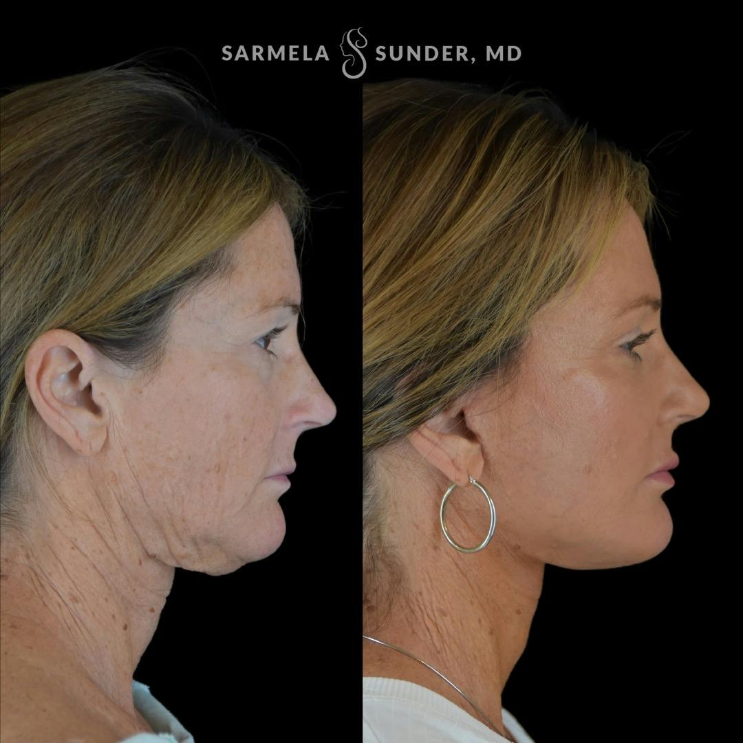 Facelift Before & After Gallery - Patient 230825 - Image 2