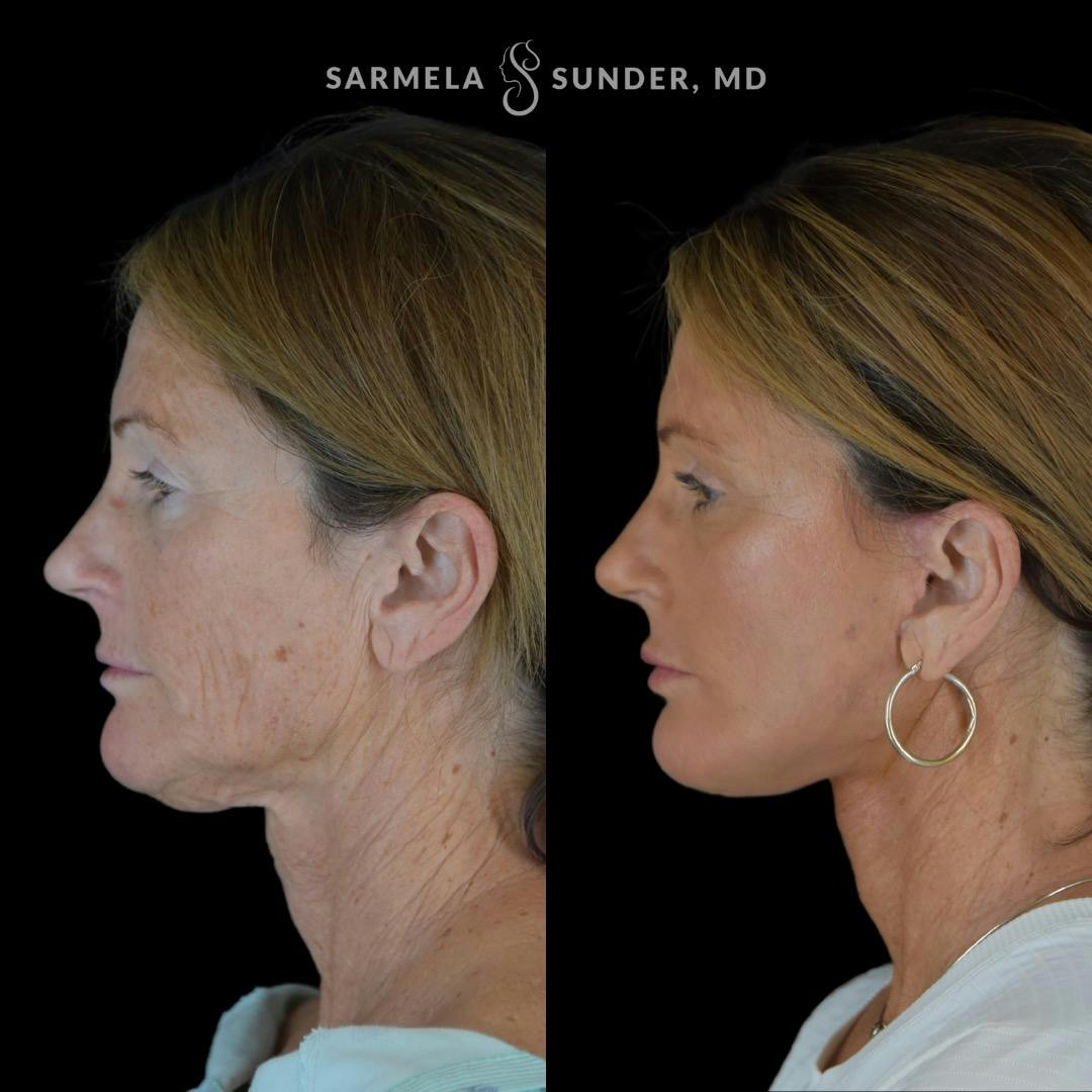 Facelift Before & After Gallery - Patient 230825 - Image 3