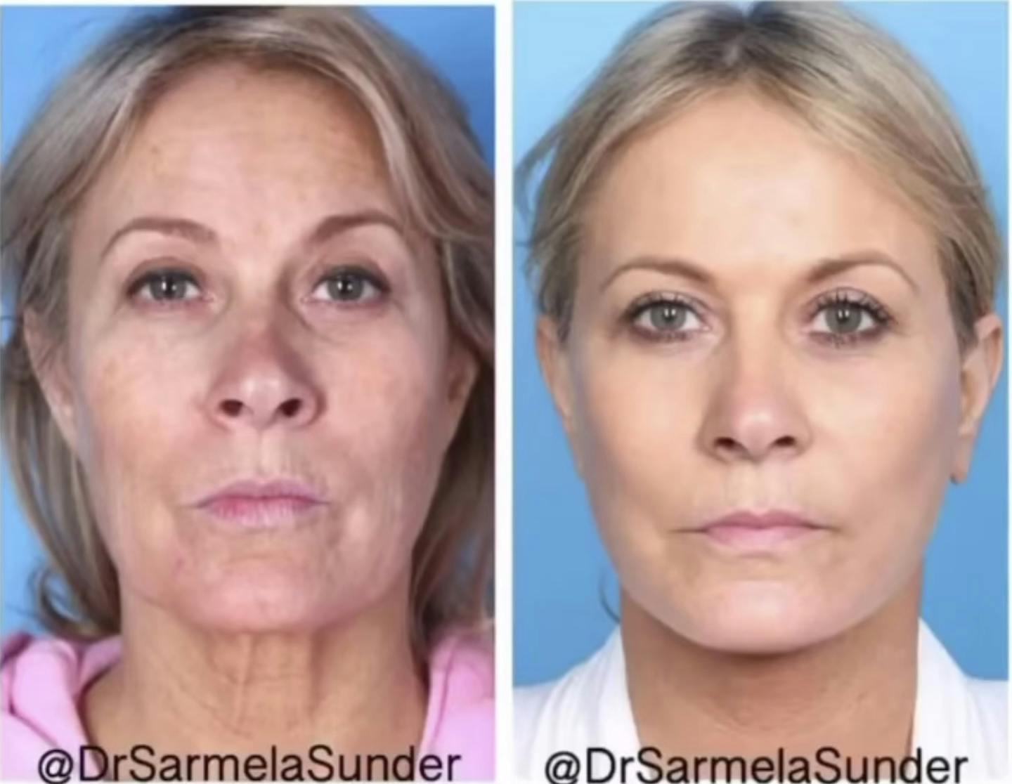 Facelift Before & After Gallery - Patient 776604 - Image 1