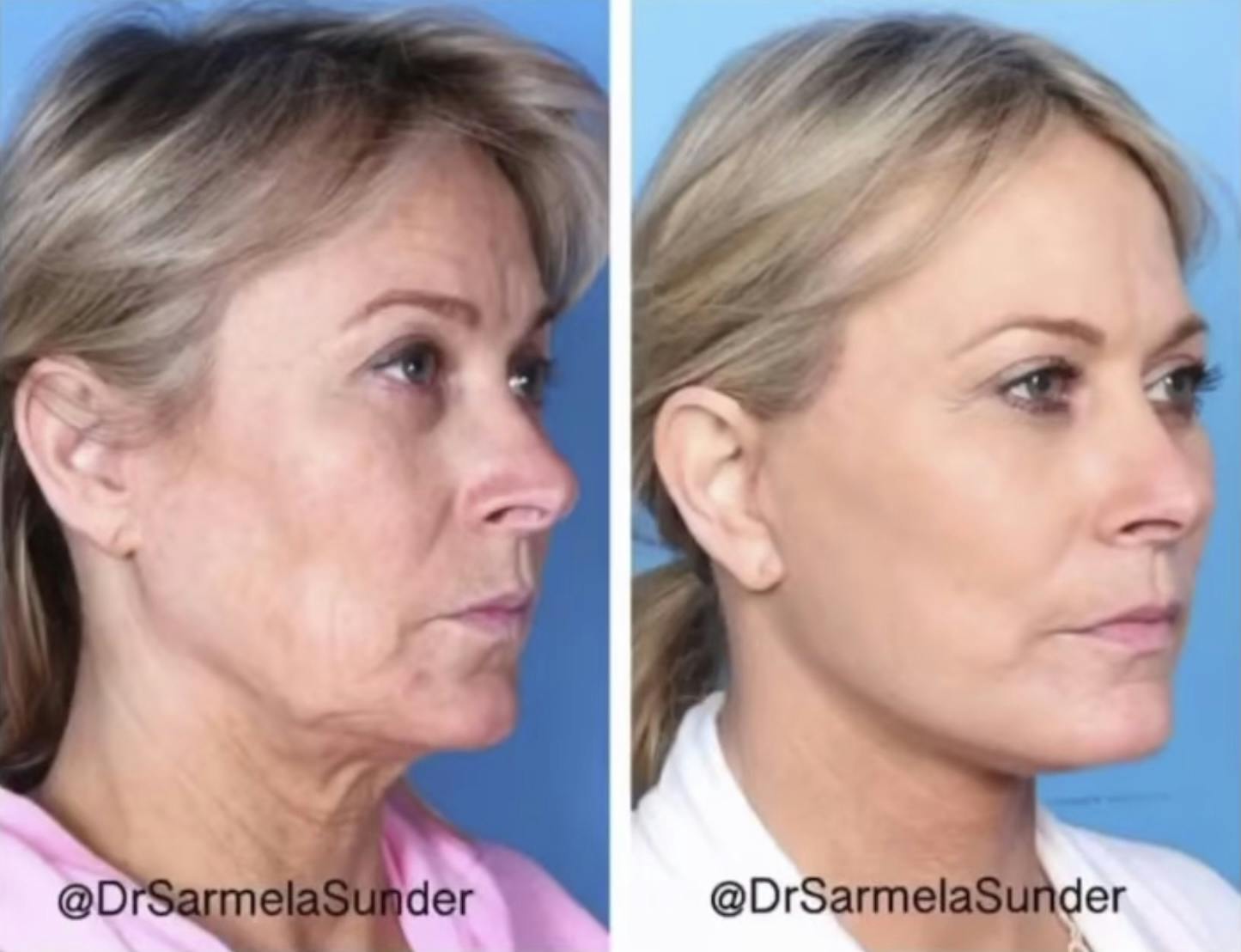 Facelift Before & After Gallery - Patient 776604 - Image 2