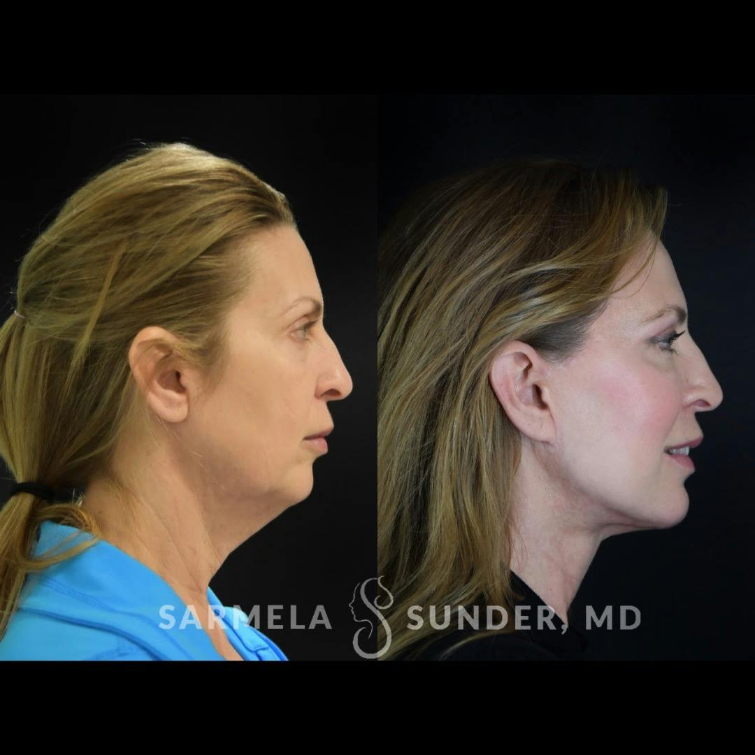 Facelift Before & After Gallery - Patient 422928 - Image 1