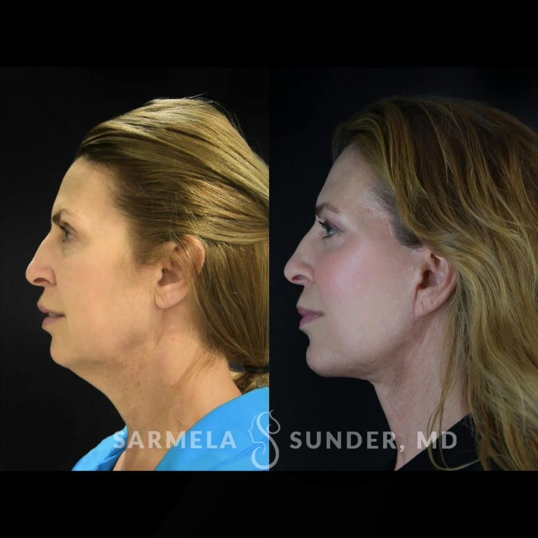 Facelift Before & After Gallery - Patient 422928 - Image 2
