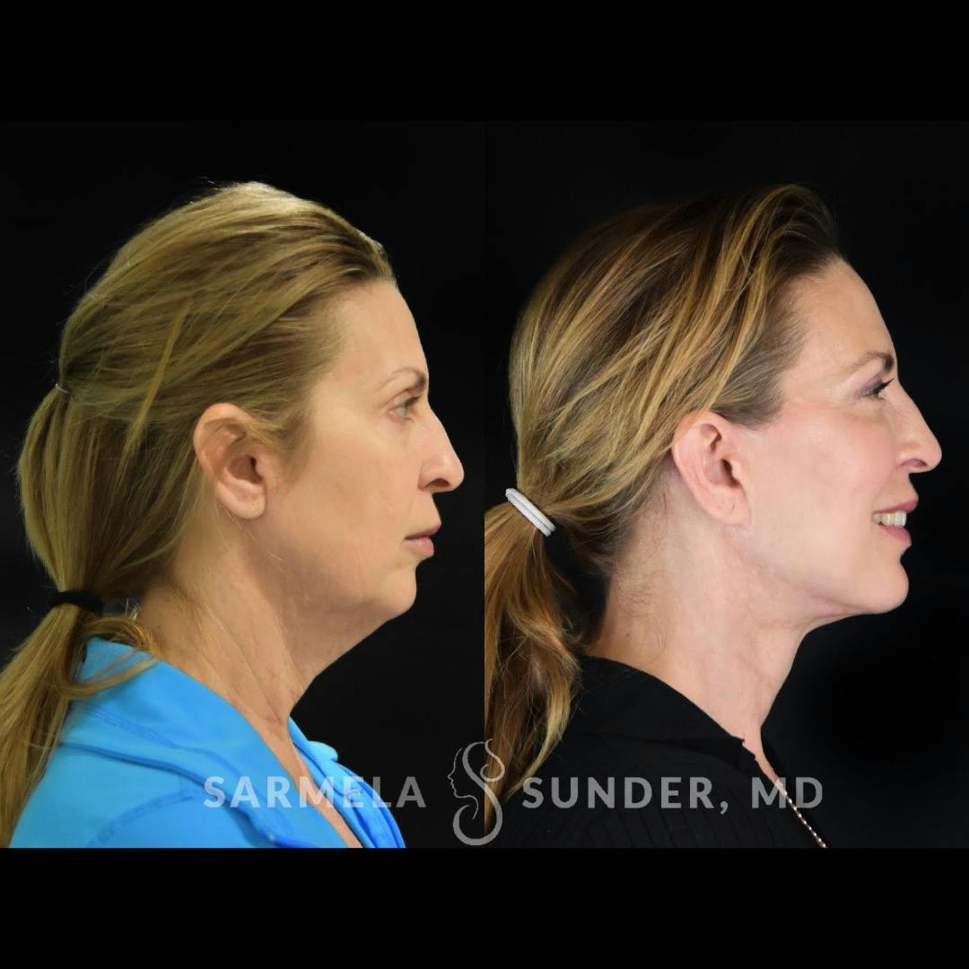 Facelift Before & After Gallery - Patient 422928 - Image 3
