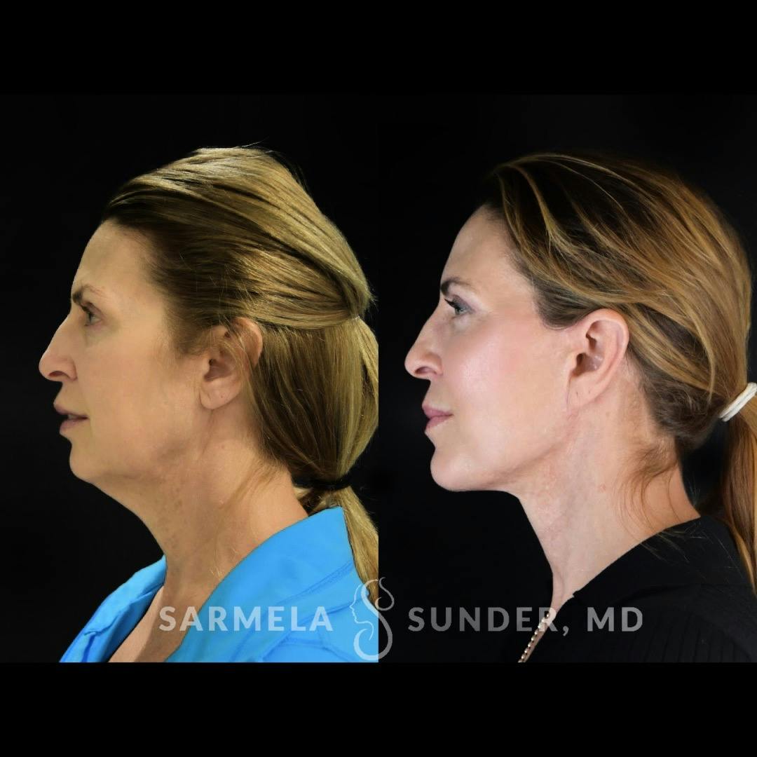 Facelift Before & After Gallery - Patient 422928 - Image 4