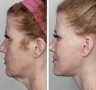 Facelift Before & After Gallery - Patient 341365 - Image 1