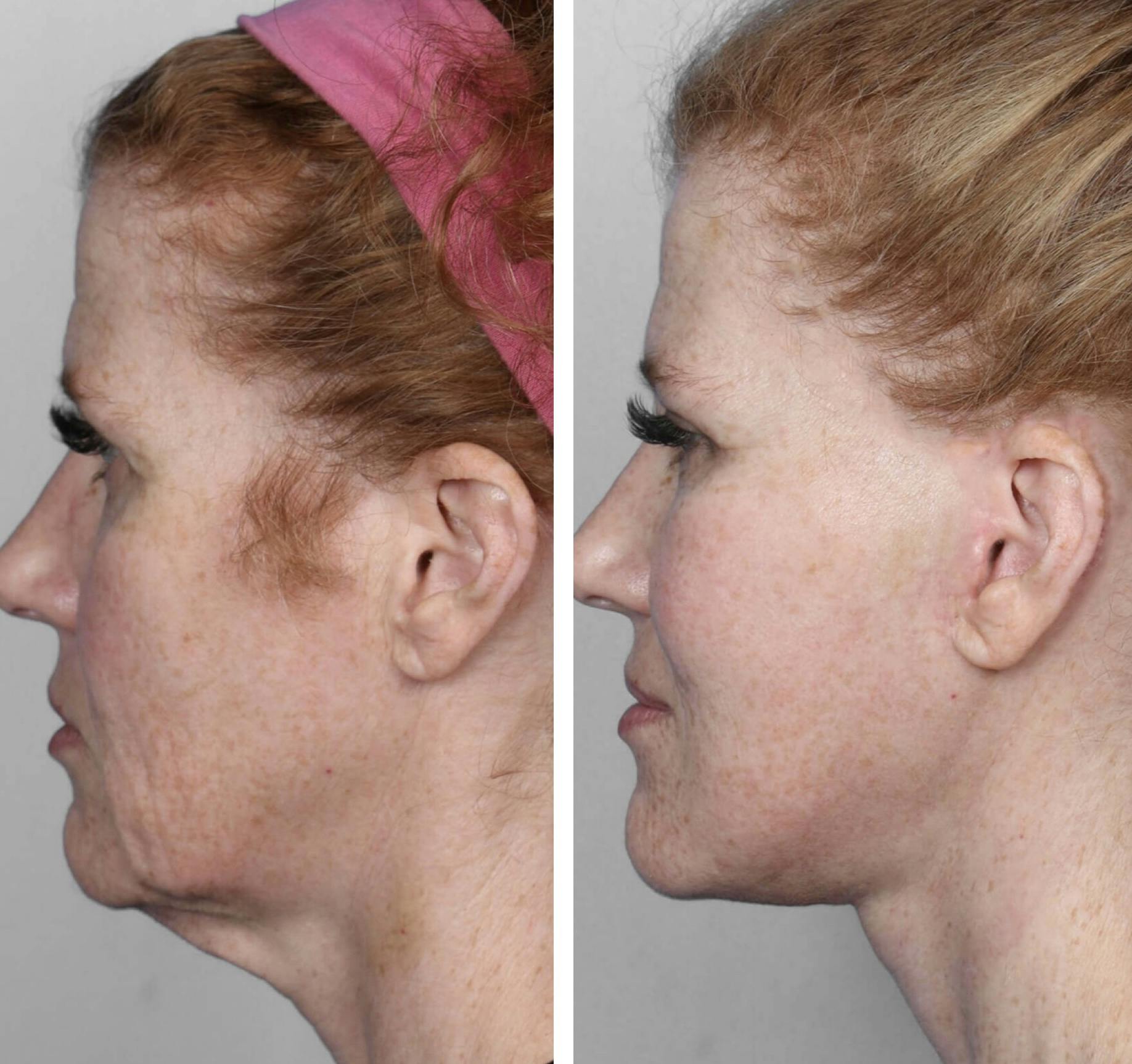 Facelift Before & After Gallery - Patient 341365 - Image 1