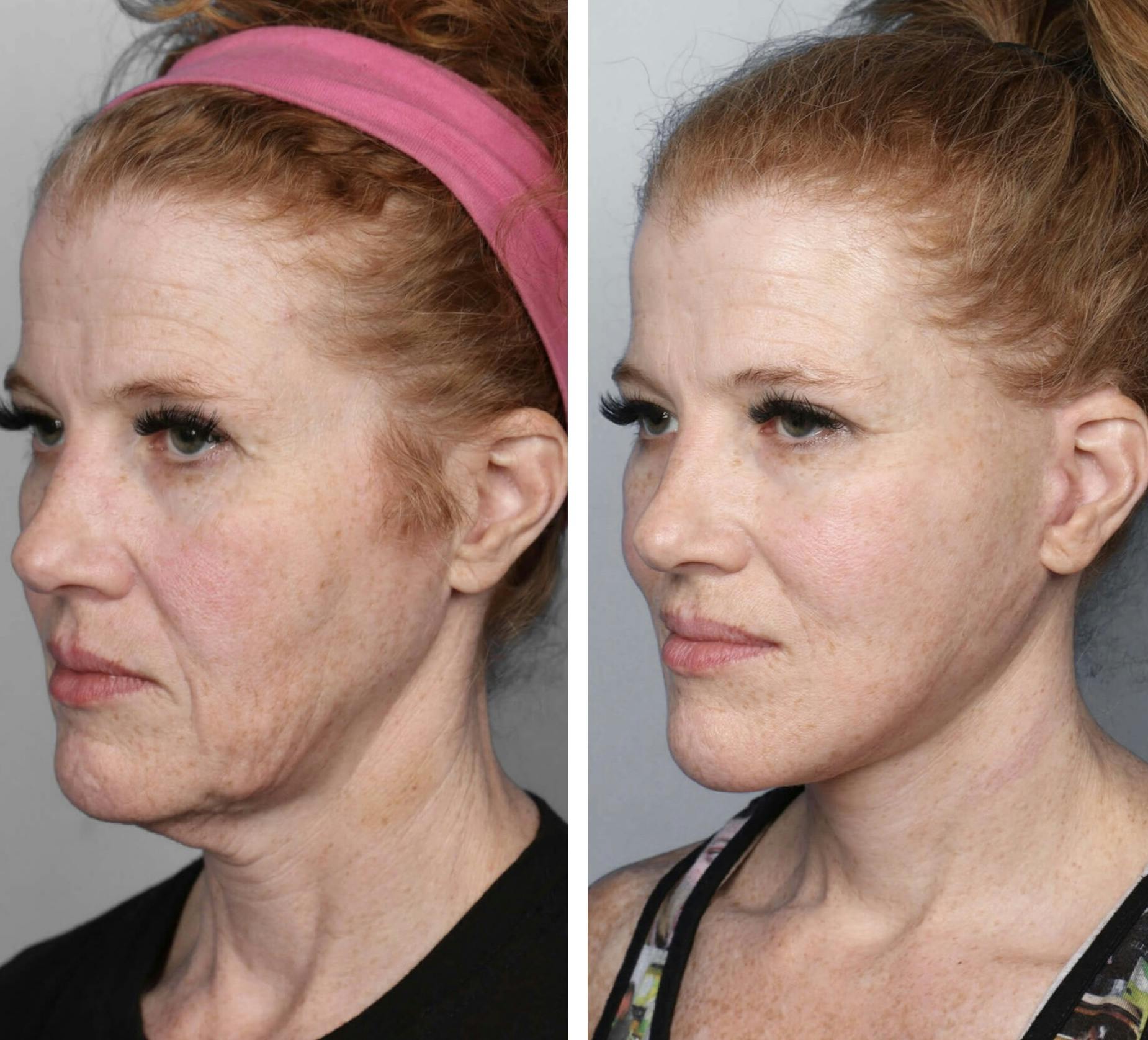 Facelift Before & After Gallery - Patient 341365 - Image 2
