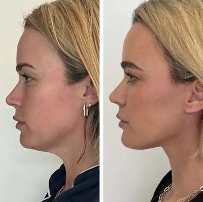 Facelift Before & After Gallery - Patient 274663 - Image 1