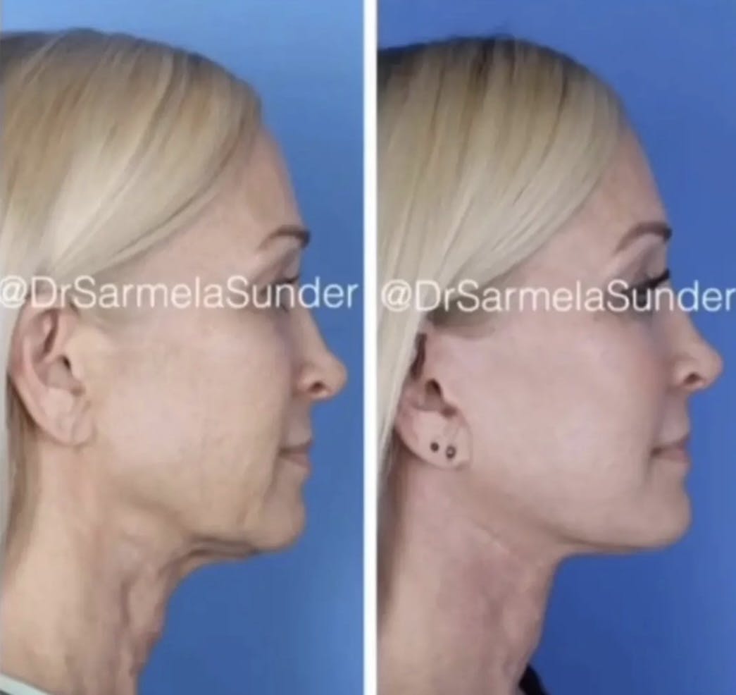 Facelift Before & After Gallery - Patient 107983 - Image 2