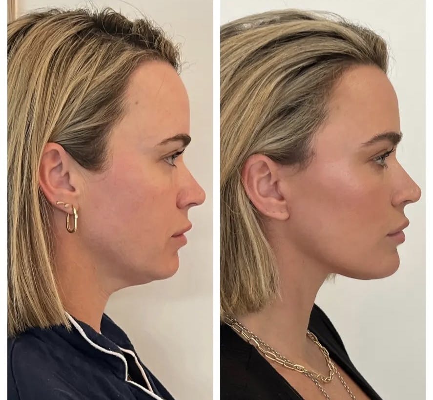Facelift Before & After Gallery - Patient 274663 - Image 2